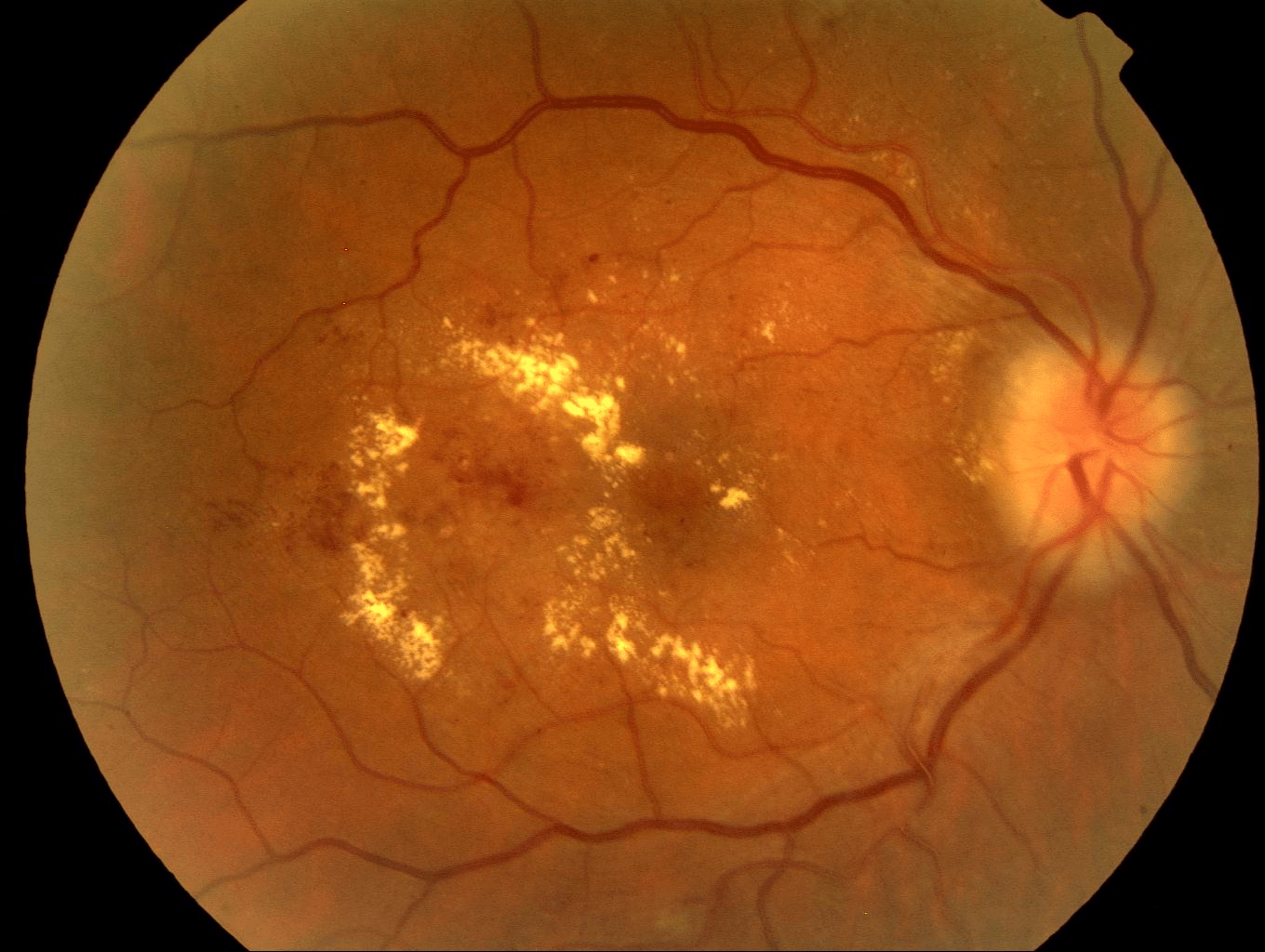 Types Of Macular Edema