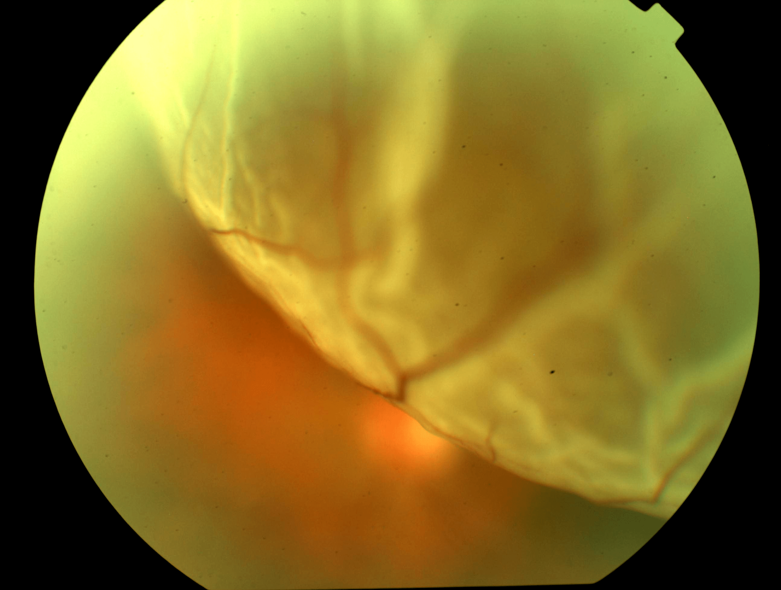 scar in eye retina