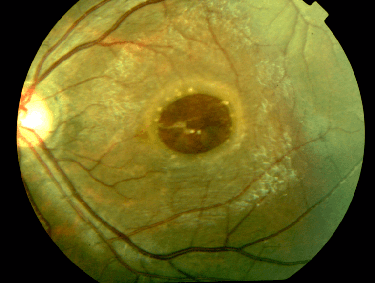 wrinkle in retina surgery