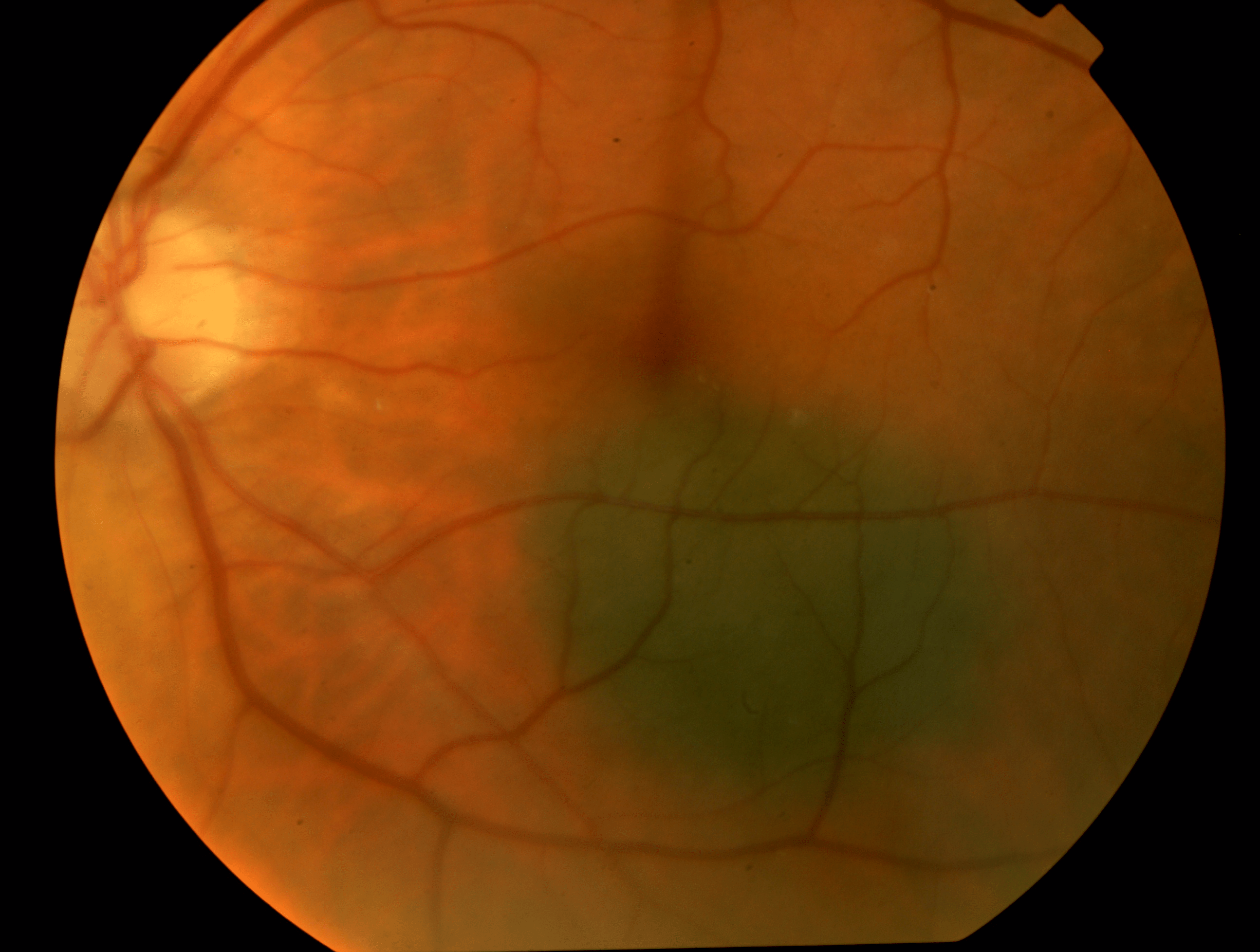 Choroidal Nevus Lipofuscin