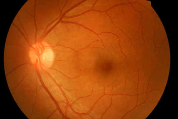 Macular Holes-Causes, Diagnosis, and Surgical Interventions featured image